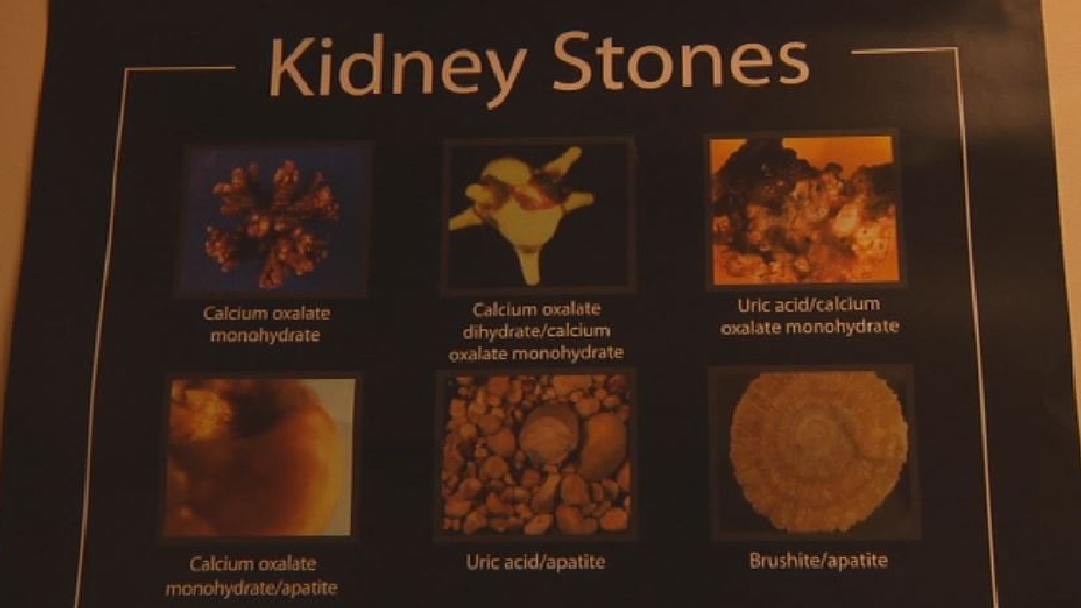 Kidney Stone Formation Due to Patients’ Lifestyle